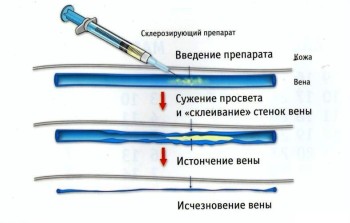 Склеротерапія