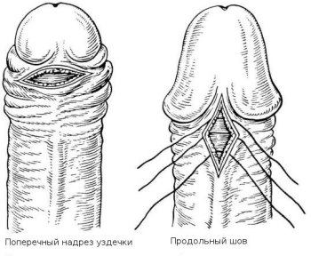 різні розрізи при пластики вуздечки