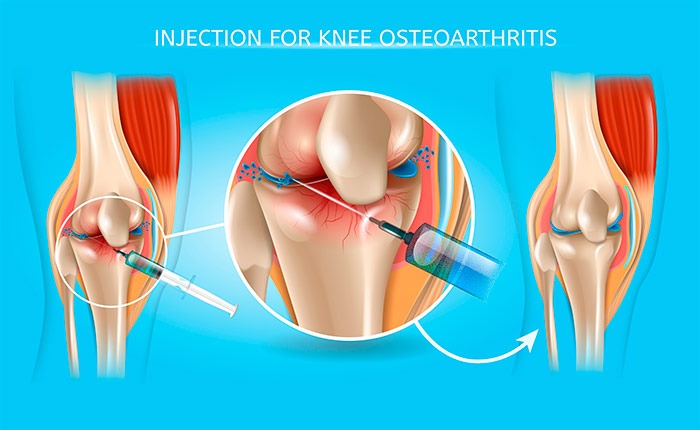 Уколы гиалуроновой кислоты в коленный сустав