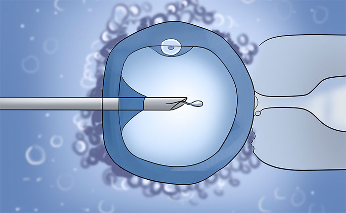 Метод ІКСІ в гінекології
